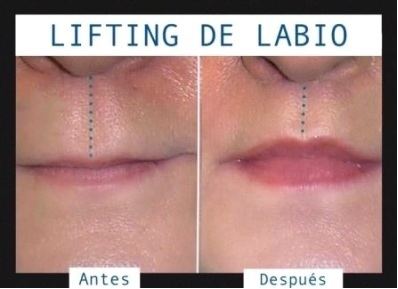 lifting labio superior